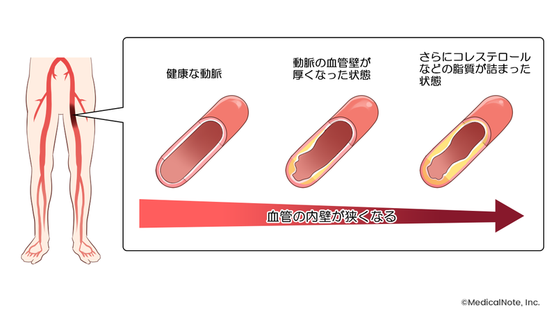 放っておくと怖い…EDは動脈硬化の初期症状⁉