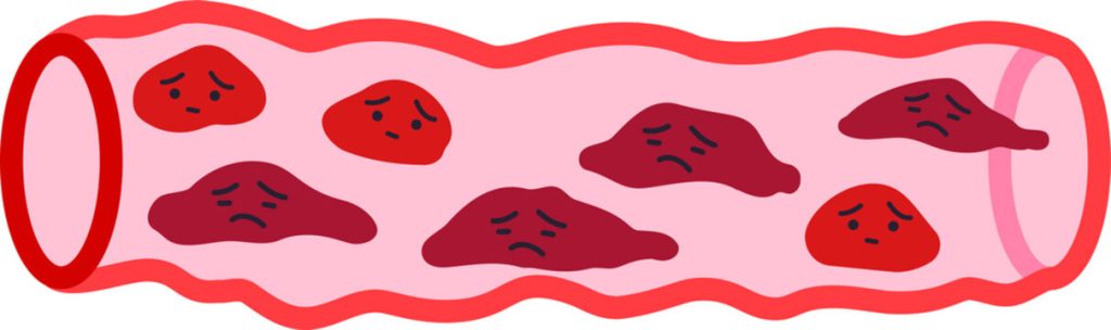 ＬＤＬ(悪玉コレステロール)より怖い“〇〇ＬＤＬ”